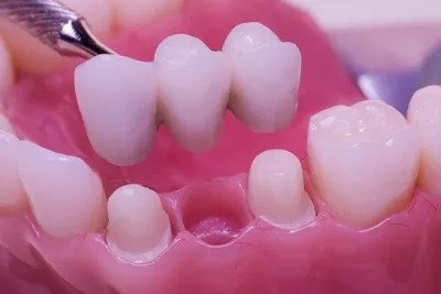 DENTAL BRIDGES DENTURES AND PARTIALS