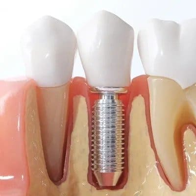 DENTAL IMPLANTS