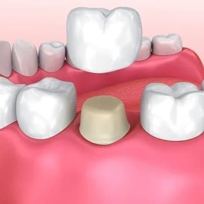 DENTAL CROWNS AND VENEERS