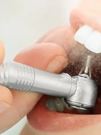 FILLINGS AND ROOT CANALS