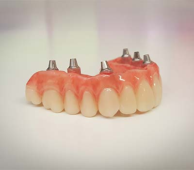 DENTURES PARTIAL BRIDGES